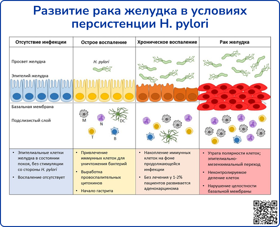 Развитие рака желудка